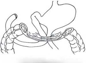胃大部切除后残胃与空肠吻合,在吻合口后方遗留的间隙称为吻合口后