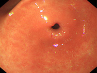 慢性<em>糜烂性胃炎</em>,慢性<em>糜烂性胃炎</em>如何治疗,慢性