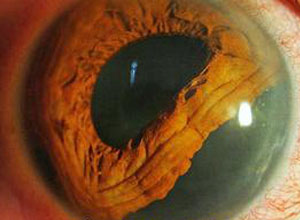 当饨力从正面作用于眼球后的一瞬间,瞳孔发生阻滞,周边巩膜扩张,潴留