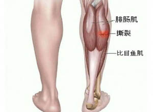 什么是进行性肌肉强直 3081.jpg