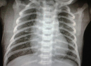 回答(6)新生儿湿肺该怎么办呢?