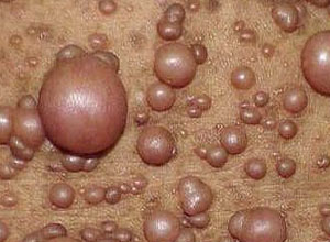 回答(2)本人右大腿为腱鞘纤维瘤