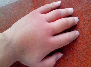 得了遗传性血管性水肿怎么治疗