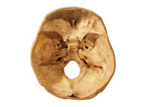 颅底骨折,颅底骨折如何治疗,颅底骨折的症状-内科-心内科-寻医问药