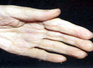 回答(4)肌萎缩性侧索硬化症?