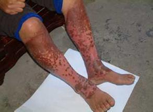 回答(2)如何根治化学烧伤?