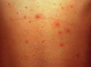 回答(1)请问 卡波西肉瘤传染吗?