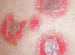 什么是线状iga大疱性皮肤病