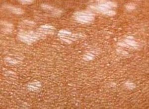 回答(1)我得是硬化萎缩苔藓型,现在溃疡,请问专.