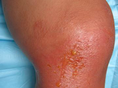 蔬菜皮炎 疾病知识 医疗资源 饮食宜忌 相关图册 轻者,趾间皮肤呈浸渍