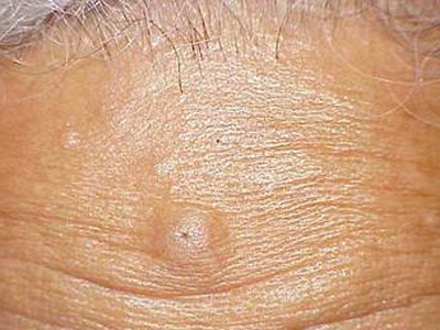 表皮样囊肿可发生在各个年龄段,甚至在尸检中可以发现.