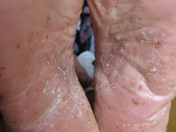 结节性痒疹是一种慢性炎症性皮肤病,以剧痒和结节性损害为特征.