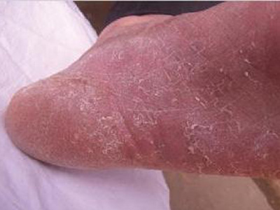 皮脂缺乏症(asteatosis)皮脂腺分泌的减少或缺乏造成皮肤干燥,又称干