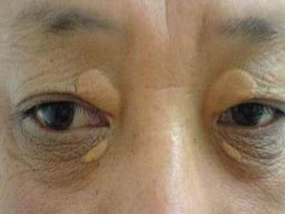小儿弹性假黄瘤的图册