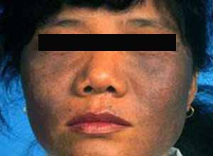 皮肤黑变,皮肤黑变的原因,皮肤黑变怎么办-皮肤性病科-皮肤科-症状