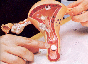 阴道流出黄色或血性带臭味的分泌物